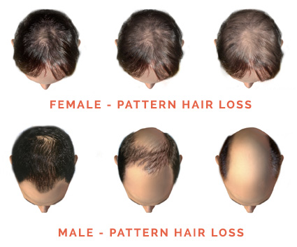 Male and Female Pattern Baldness
